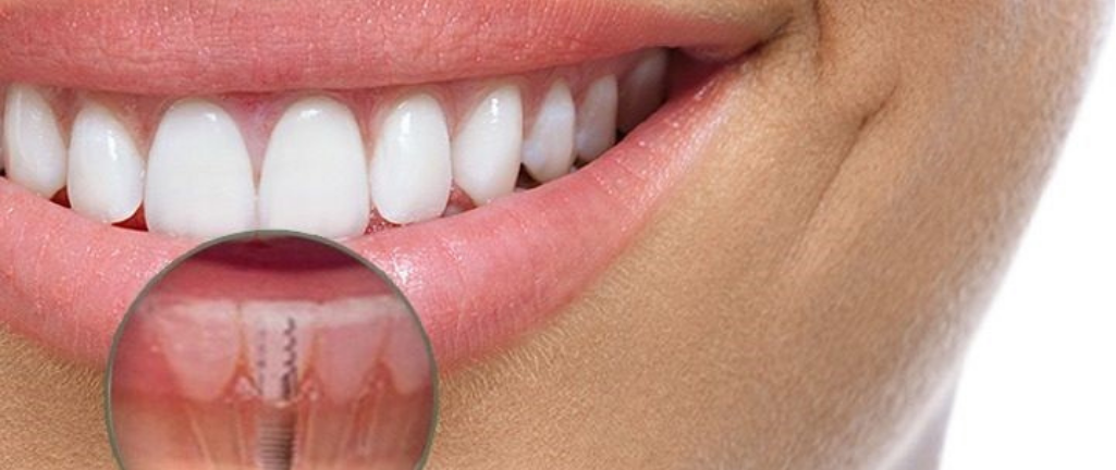 Implantes Dentários: A solução definitiva