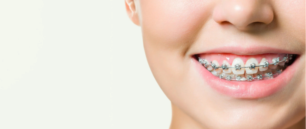 Sorriso com braquetes metálicos